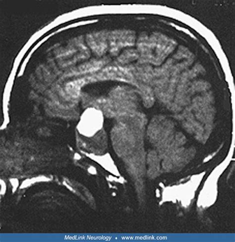 Pituitary apoplexy | MedLink Neurology