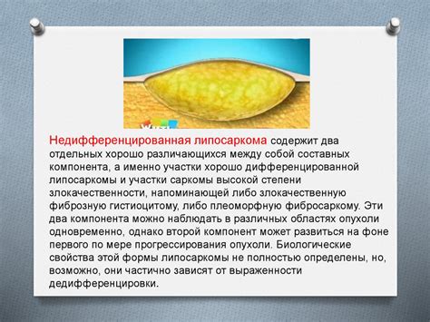 Липома и липосаркома - презентация онлайн