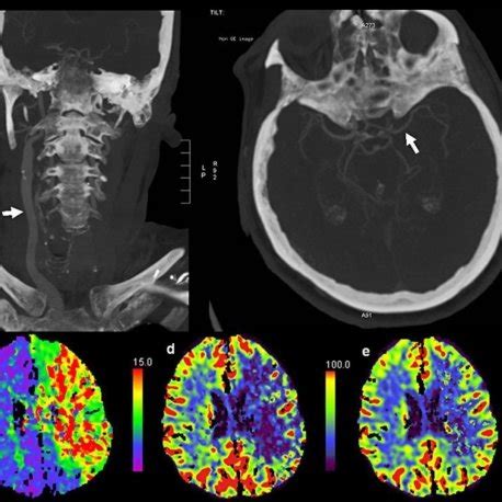 At day 7 after acute left-sided hemiparesis and neglect due to ...