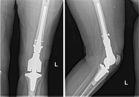 Anteroposterior And Lateral Radiograph Of The Left Knee At 1 Year Download Scientific Diagram