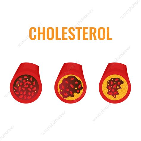 Atherosclerosis Conceptual Illustration Stock Image F