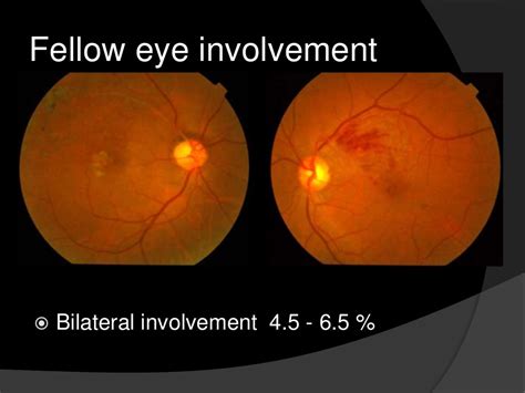 Branch Retinal Vein Occlusion