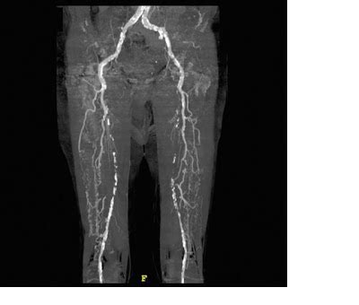 CT Physics 2009 Maximum Intensity Projection