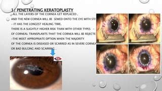 Keratoplasty | PPT