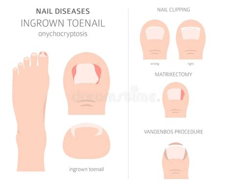 Enfermedades De Las Uñas Onicomicosis Infección Por Hongos En Uñas