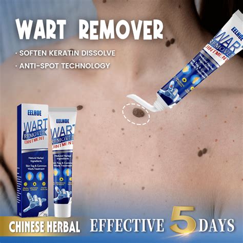 Warts Remover Original Watson Warts Removal Kasoy Oil Warts Remover