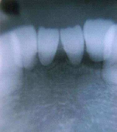 Intra Oral Periapical Radiograph Showing Lower Central Incisors