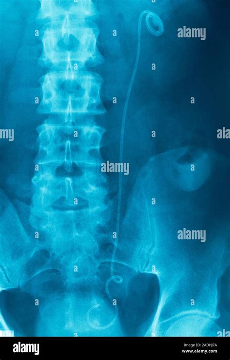 Urinary System Stent X Ray Of A Jj Stent Down Centre In A Urinary