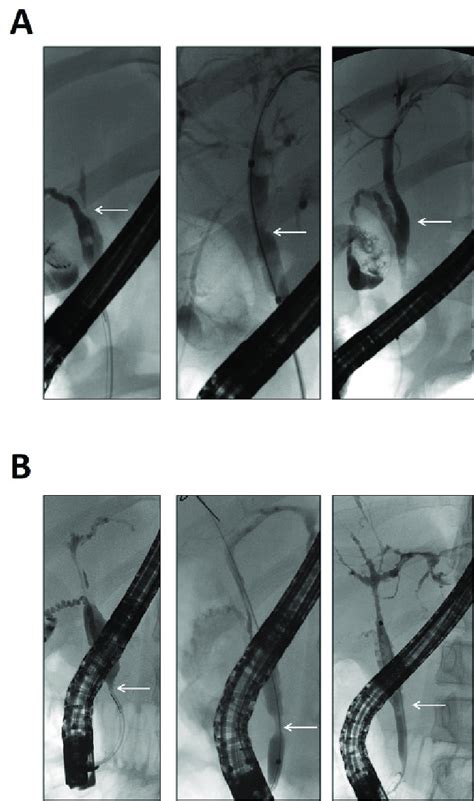 Endoscopic Treatment Until Morphological Resolution Of Dominant