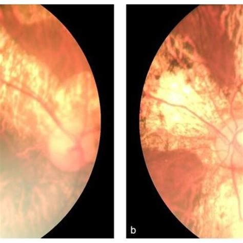 Fundus Photograph Of The Right Eye A And The Left Eye B From The Download Scientific