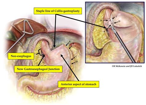 The Laparoscopic Approach To Paraesophageal Hernia Repair Abstract