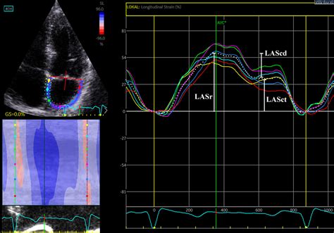 Left Atrial Contractile Strain Predicts Recurrence Of Atrial