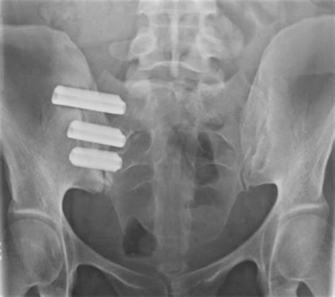 Postoperative Radiograph Demonstrating Placement Of Three Implants