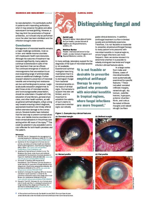 Pdf Distinguishing Fungal And Bacterial Keratitis On Clinical Signs Astrid Leck