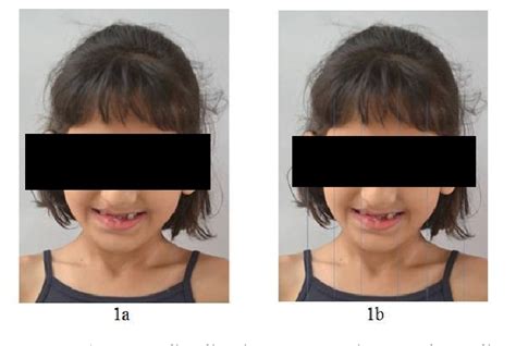 Figure 1 From Van Der Woude Syndrome A Rare Case Report With Brief