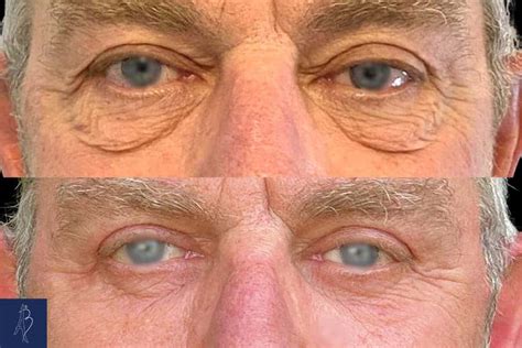 Blépharoplastie inférieure à Paris Traitement des cernes sous les yeux