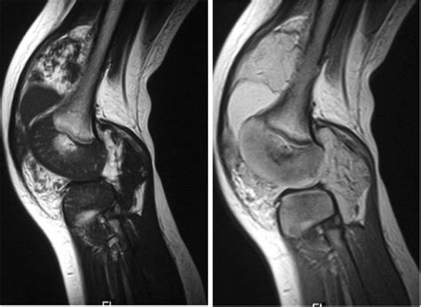 Knee MRI Of Patient 1 Sagittal T1 And T2 Weighted Images Show The