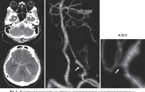 Figure 1 From Successful Treatment Of Ruptured Dissecting Vertebral