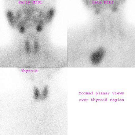 Parathyroid adenoma | Radiology Reference Article | Radiopaedia.org