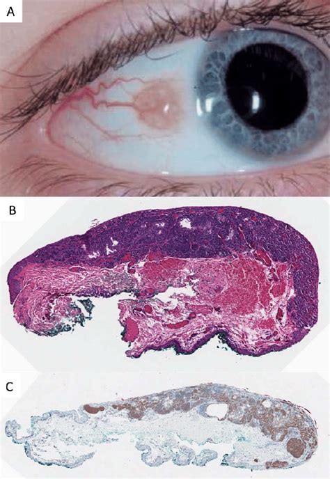 Conjunctival Nevus Occurring In Childhood A Clinical Photo