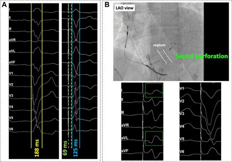 Failure Of Left Bundle Branch Pacing Owing To Iterative Septal