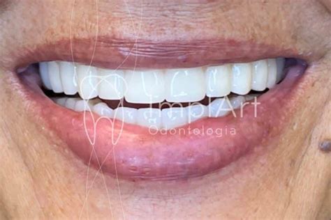 Protocolo Em Zirc Nia Implante Completo Zirconia Implart