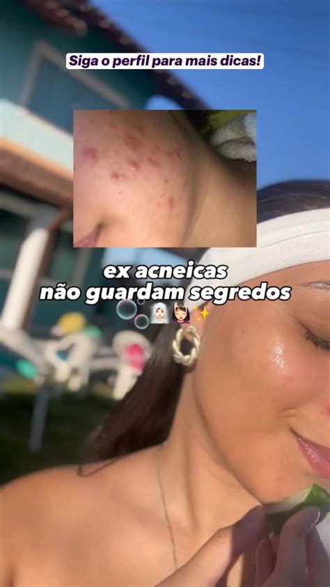 Siga O Perfil Para Mais Dicas Quer Ter A Pele Perfeita E Sem Acne Em