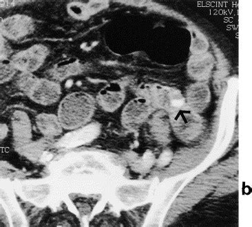 Multiple Jejunal Angiodysplasia Detected By Enema Helical CT Clinical