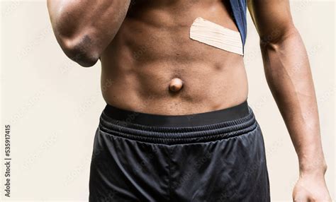 Close up: African American adult man navel with Umbilical hernia, a ...