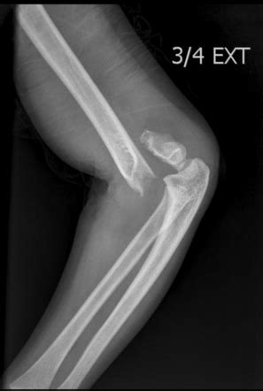 Supracondylar Fracture Radiology Case Radiopaedia Org