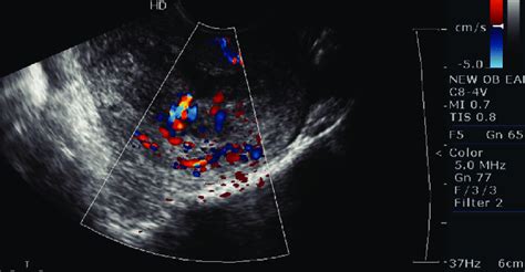 Transvaginal Doppler Ultrasound Of The Uterus Shows Enlarged High Images