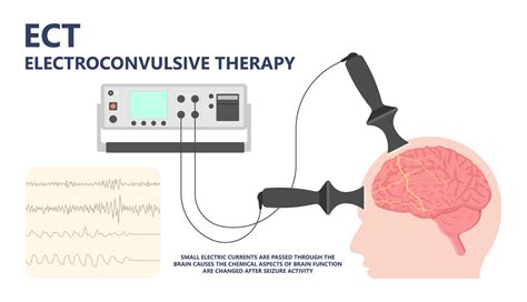 How Does Electroconvulsive Therapy Work Scienceabc