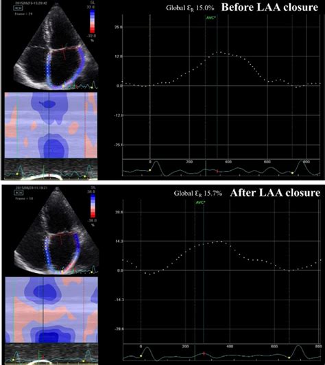 Does Percutaneous Left Atrial Appendage Closure Affect Left Atrial