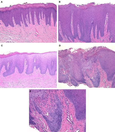 Acanthosis Histology