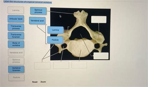 Solved Label The Structures Of A Typical Cervical Vertebra Chegg