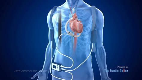 Left Ventricular Assist Device Lvad Video Medical Video Library