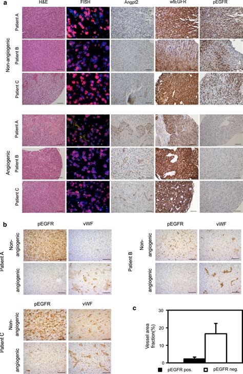 Egfr Activation Promotes Invasive Non Angiogenic Tumor Growth In Gbm