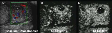 Epididymal abscess. A) Baseline color Doppler examination shows a round ...