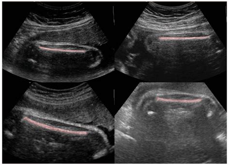 Figure 3 From Automatic Entropy Based Femur Segmentation And Fast Length Measurement For Fetal