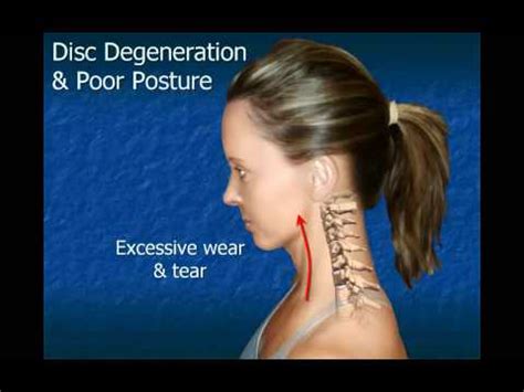 Trapped Nerve: Yoga Exercises For Trapped Nerve In Neck