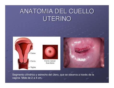 Precancer De Cervix