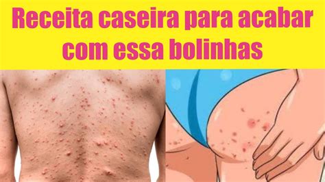 COMO ACABAR BOLINHAS NO BUMBUM RECEITA CASEIRA YouTube