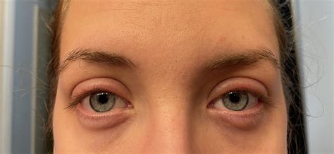 Swollen Eyelid From Makeup Treatment