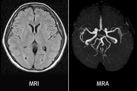 出血性梗塞 Hemorrhagic Infarct Japaneseclass Jp