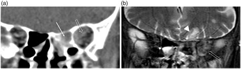 Imaging Review Of The Anterior Skull Base Olivia Francies Levan