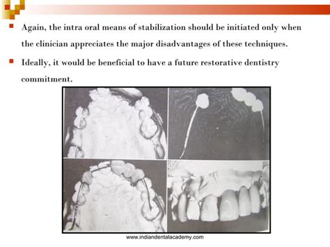 Splinting Part2 Certified Fixed Orthodontic Courses By Indian Dental Academy Ppt