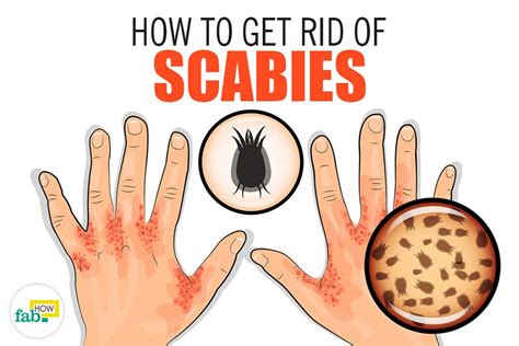 How to Get Rid of Scabies With Home Remedies | Fab How