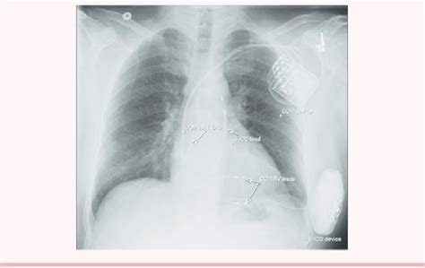 Posteroanterior Pa Chest X Ray View Of A Patient With Subcutaneous