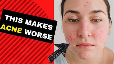 Stop Making Acne Worse Youtube