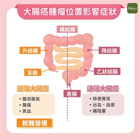 右側大腸癌比左側還難發現 一圖看懂左右側大腸癌症狀區別｜大腸直腸癌｜癌症｜元氣網